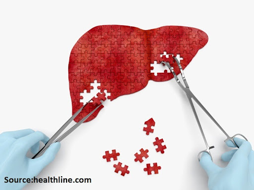 Liver Biopsy