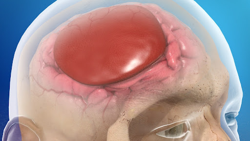 Subdural Hematoma